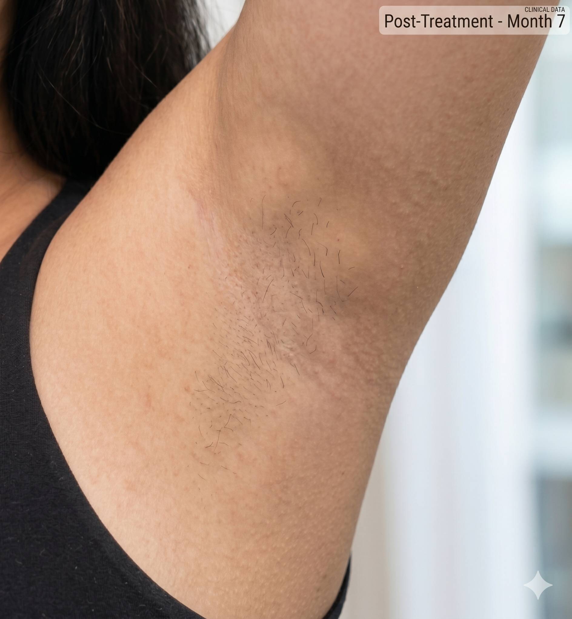 After 6 sessions of laser hair reduction