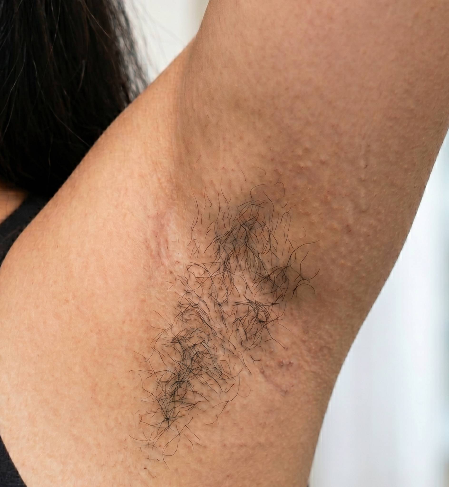 Before laser hair reduction